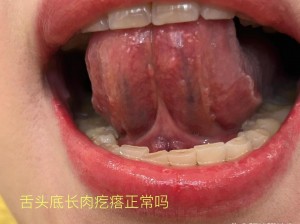 舌头能舔到口腔下颚有硬疙瘩图片：口腔下颚硬疙瘩可能是正常结构，也可能是疾病表现