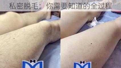 私密脱毛：你需要知道的全过程