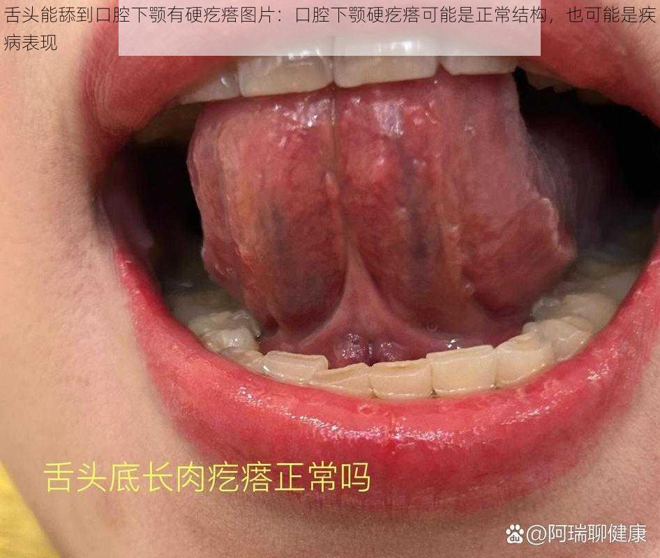 舌头能舔到口腔下颚有硬疙瘩图片：口腔下颚硬疙瘩可能是正常结构，也可能是疾病表现